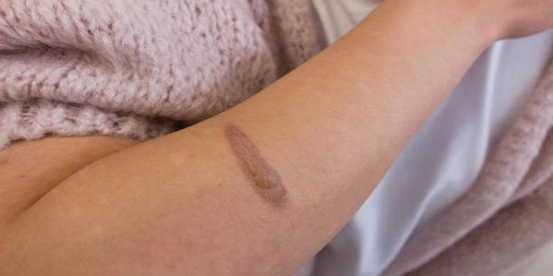 Reclaiming Confidence: Effective Solutions for Burn Scar Disfigurement